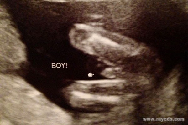 在超声图像上，胎儿的两腿之间有一个圆形的东西。