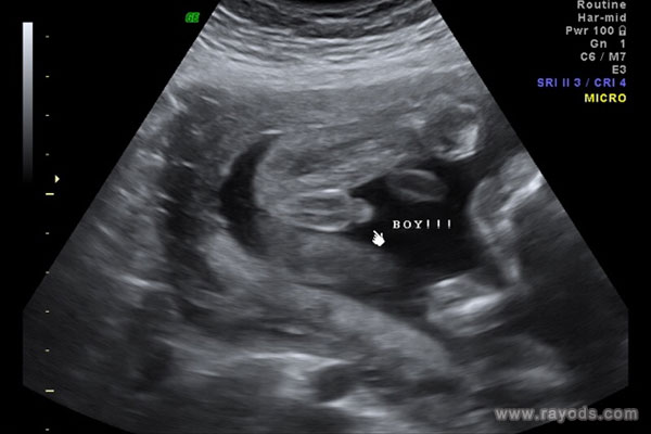 在超声图像上，胎儿的两腿之间有一个圆形的东西。